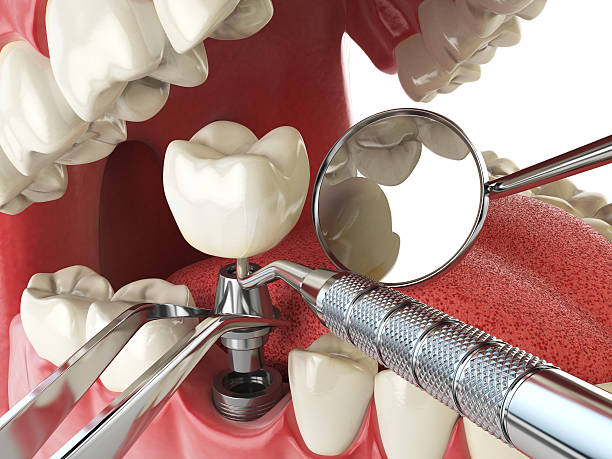 Best Emergency Treatment for Dental Infections or Abscesses in Atlantic Beach, NC